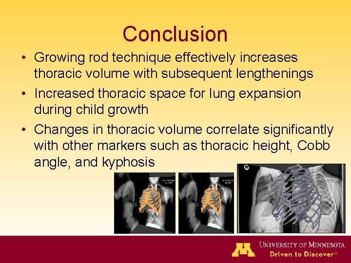 Conclusion • Growing rod technique effectively increases thoracic volume with subsequent lengthenings • Increased