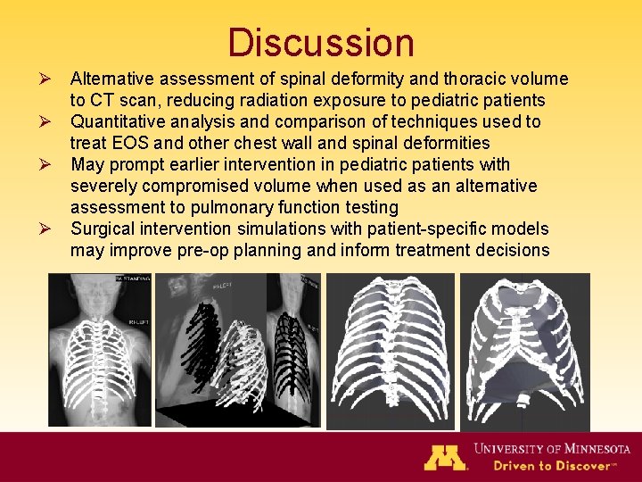 Discussion Ø Alternative assessment of spinal deformity and thoracic volume to CT scan, reducing