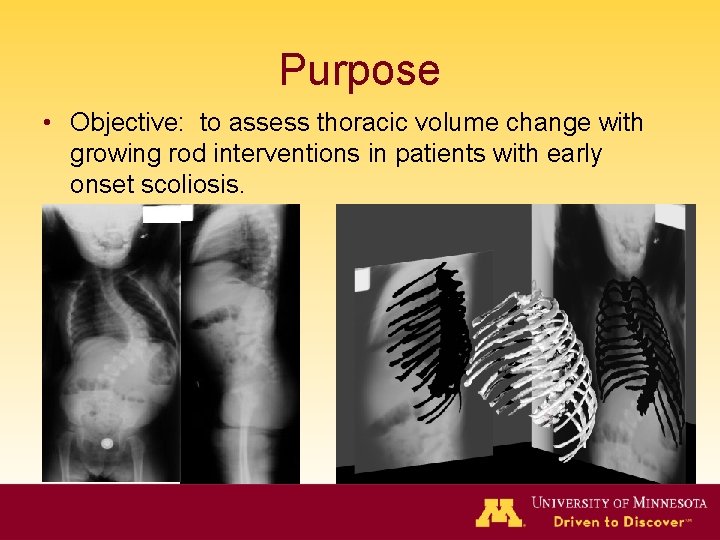 Purpose • Objective: to assess thoracic volume change with growing rod interventions in patients