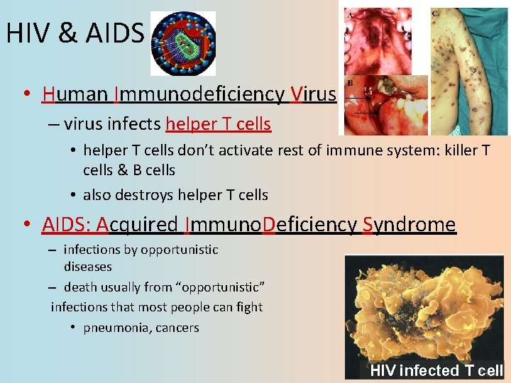 HIV & AIDS • Human Immunodeficiency Virus – virus infects helper T cells •