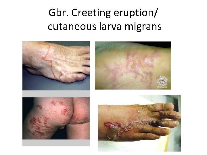 Gbr. Creeting eruption/ cutaneous larva migrans 