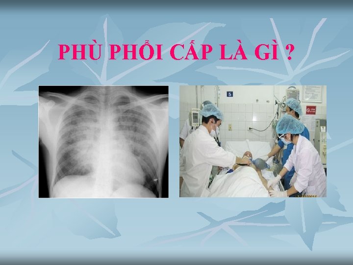 PHÙ PHỔI CẤP LÀ GÌ ? 