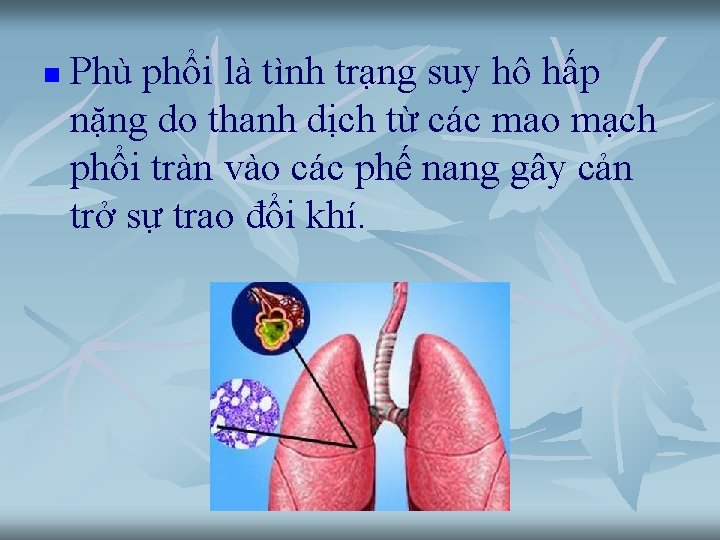 n Phù phổi là tình trạng suy hô hấp nặng do thanh dịch từ