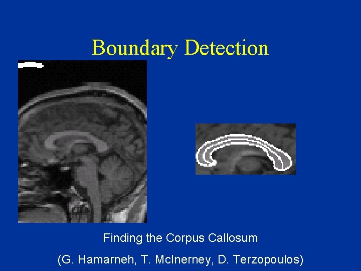 Boundary Detection Finding the Corpus Callosum (G. Hamarneh, T. Mc. Inerney, D. Terzopoulos) 