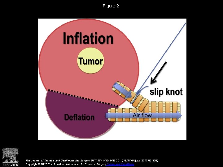 Figure 2 The Journal of Thoracic and Cardiovascular Surgery 2017 1541432 -1439 DOI: (10.