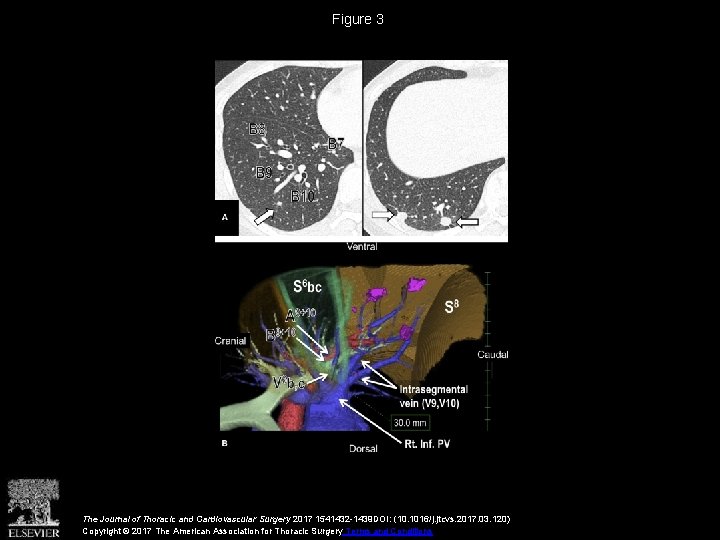 Figure 3 The Journal of Thoracic and Cardiovascular Surgery 2017 1541432 -1439 DOI: (10.