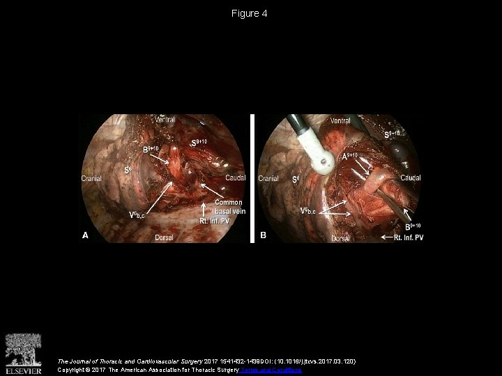 Figure 4 The Journal of Thoracic and Cardiovascular Surgery 2017 1541432 -1439 DOI: (10.