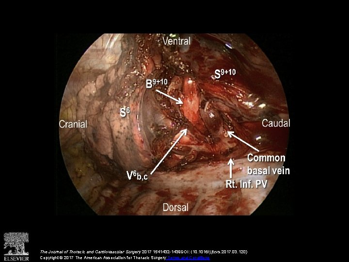 The Journal of Thoracic and Cardiovascular Surgery 2017 1541432 -1439 DOI: (10. 1016/j. jtcvs.