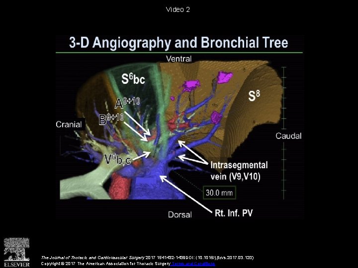 Video 2 The Journal of Thoracic and Cardiovascular Surgery 2017 1541432 -1439 DOI: (10.