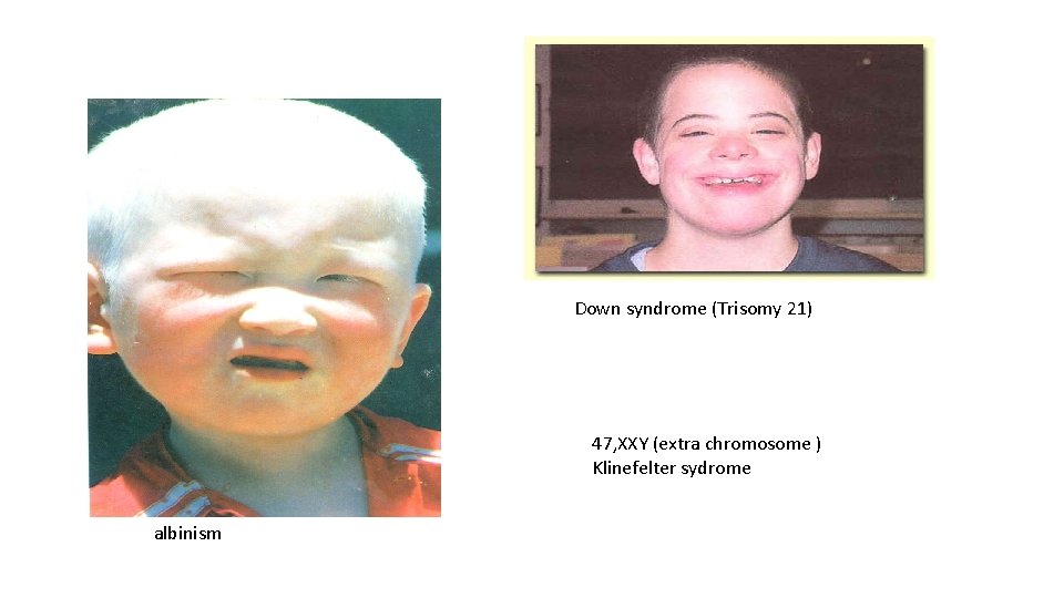 Down syndrome (Trisomy 21) 47, XXY (extra chromosome ) Klinefelter sydrome albinism 