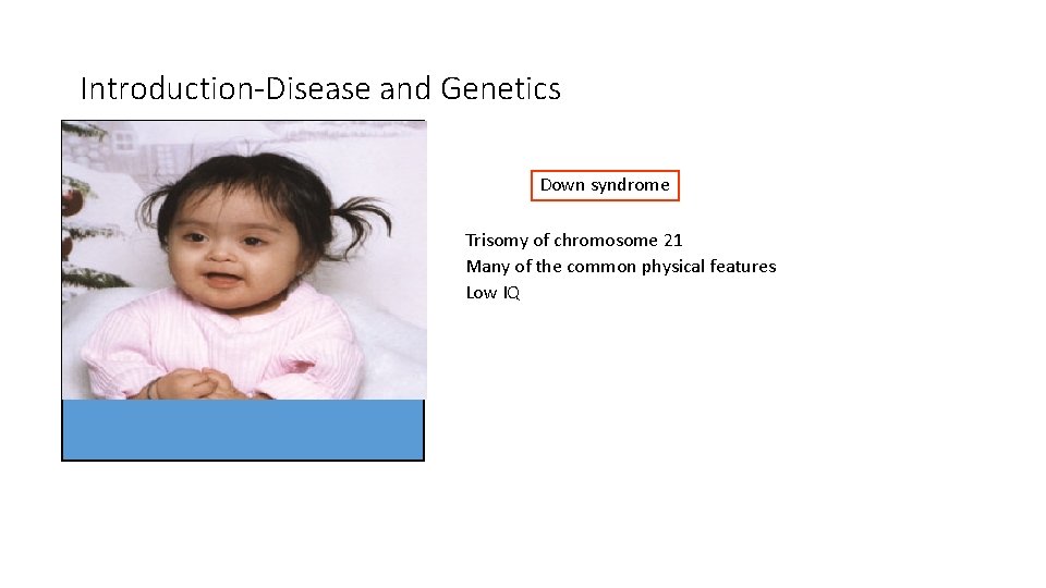 Introduction-Disease and Genetics Down syndrome Trisomy of chromosome 21 Many of the common physical