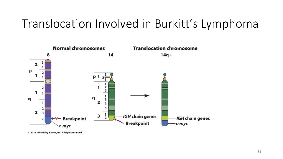 Translocation Involved in Burkitt’s Lymphoma 31 