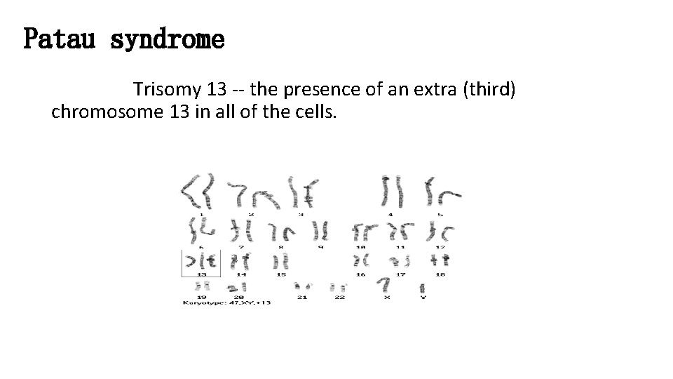 Patau syndrome Trisomy 13 -- the presence of an extra (third) chromosome 13 in