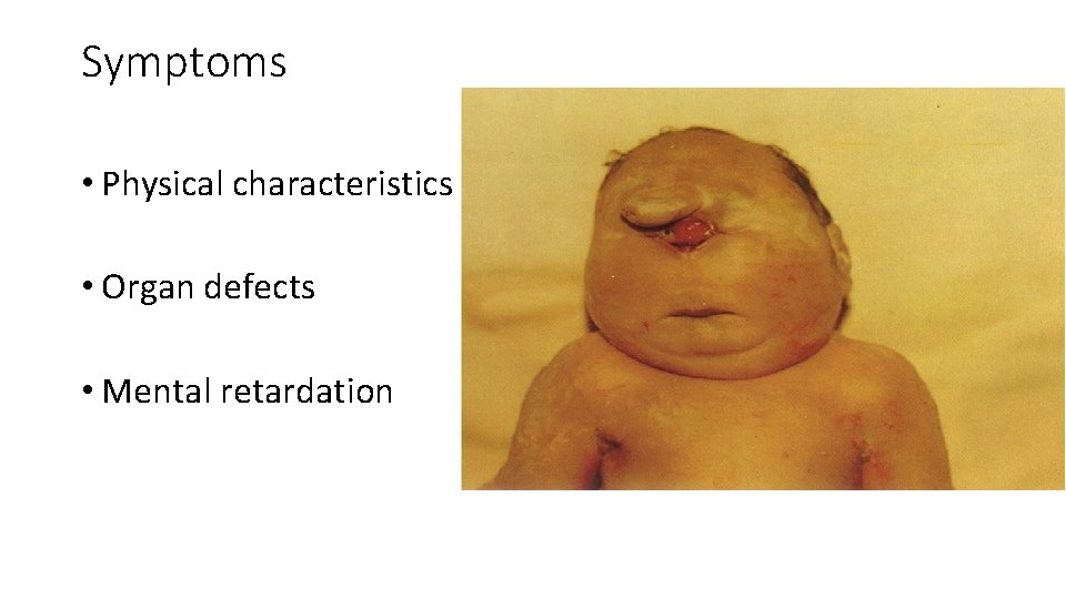 Symptoms • Physical characteristics • Organ defects • Mental retardation 