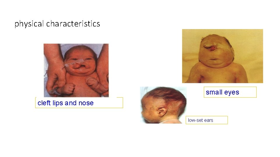 physical characteristics small eyes cleft lips and nose low-set ears 