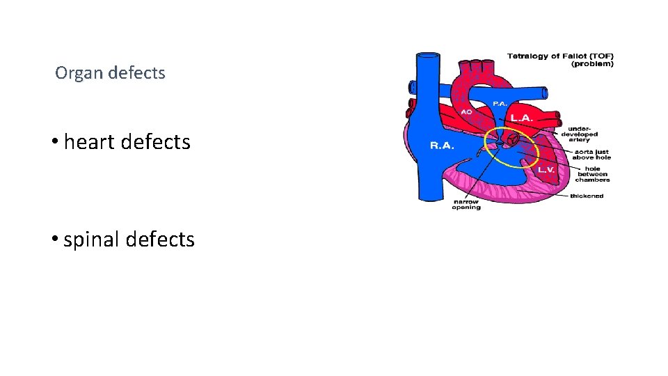 Organ defects • heart defects • spinal defects 