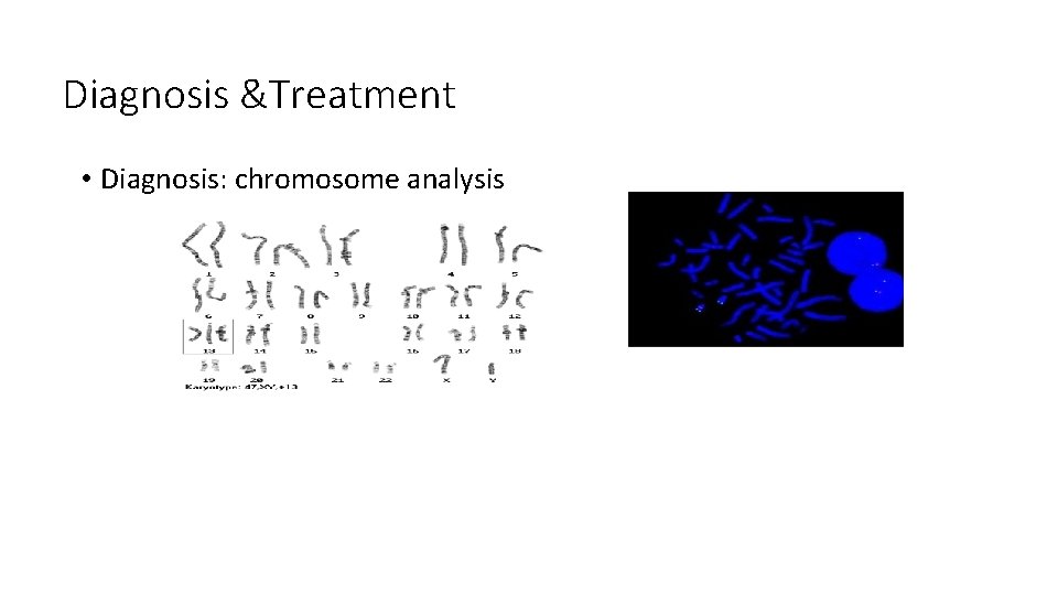 Diagnosis &Treatment • Diagnosis: chromosome analysis 