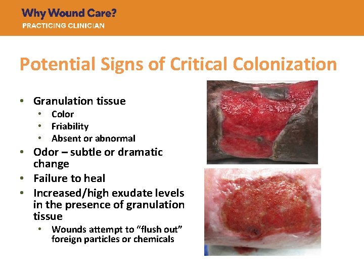 Potential Signs of Critical Colonization • Granulation tissue • Color • Friability • Absent