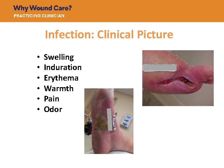 Infection: Clinical Picture • • • Swelling Induration Erythema Warmth Pain Odor 