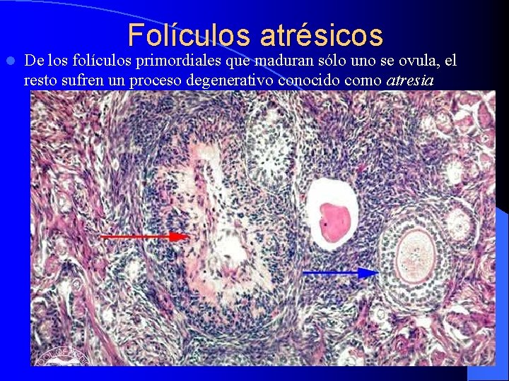 l Folículos atrésicos De los folículos primordiales que maduran sólo uno se ovula, el