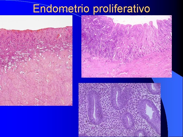 Endometrio proliferativo 