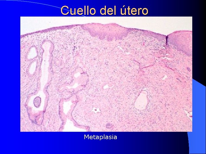 Cuello del útero Metaplasia 