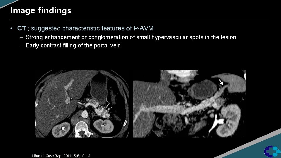 Image findings • CT ; suggested characteristic features of P-AVM – Strong enhancement or