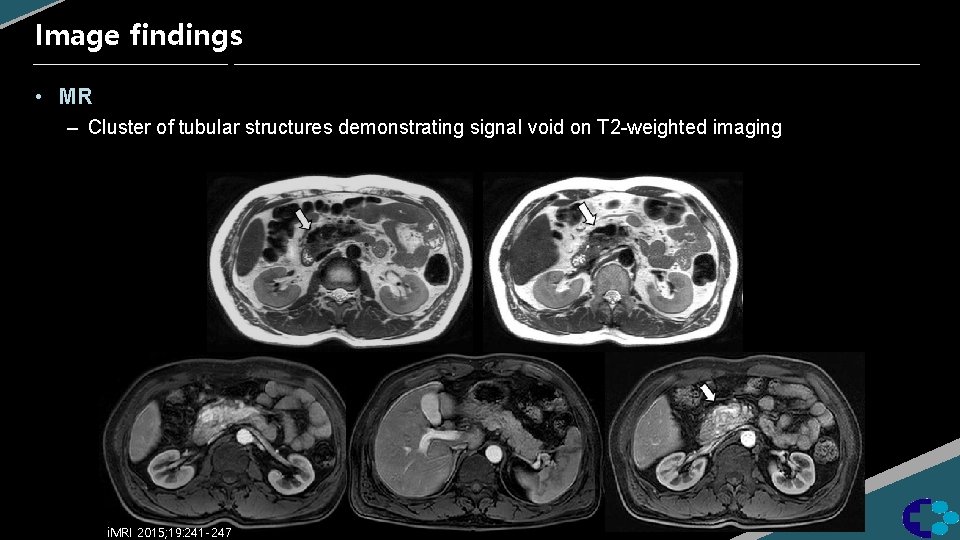 Image findings • MR – Cluster of tubular structures demonstrating signal void on T