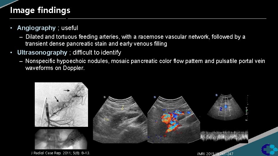 Image findings • Angiography ; useful – Dilated and tortuous feeding arteries, with a