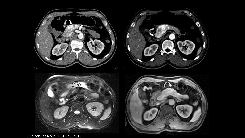 J Korean Soc Radiol 2010; 62: 257 -261 