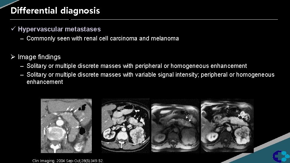 Differential diagnosis ü Hypervascular metastases – Commonly seen with renal cell carcinoma and melanoma