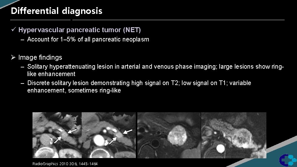 Differential diagnosis ü Hypervascular pancreatic tumor (NET) – Account for 1– 5% of all