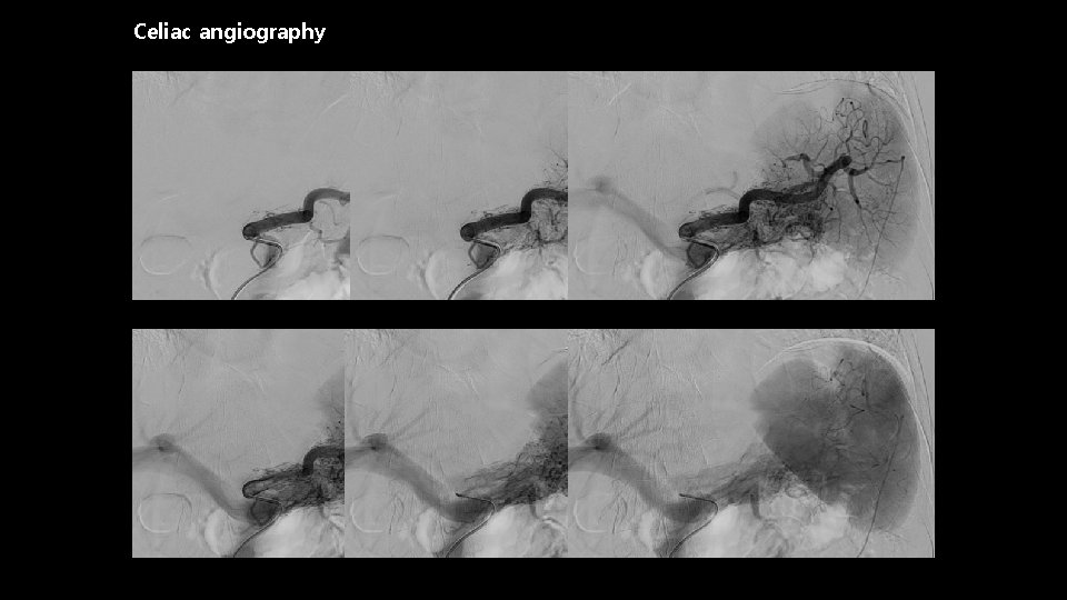 Celiac angiography 