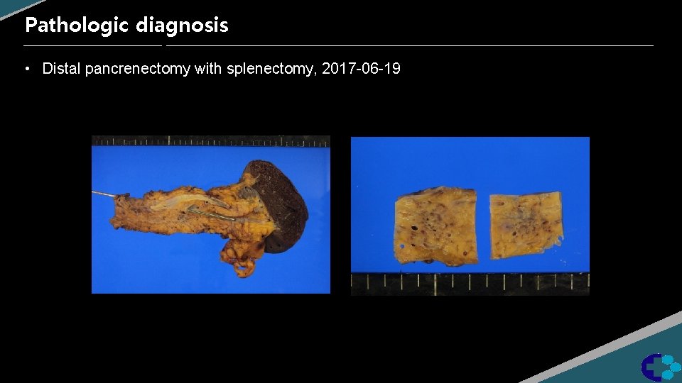 Pathologic diagnosis • Distal pancrenectomy with splenectomy, 2017 -06 -19 