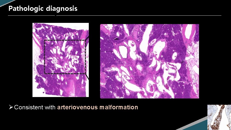 Pathologic diagnosis Ø Consistent with arteriovenous malformation 