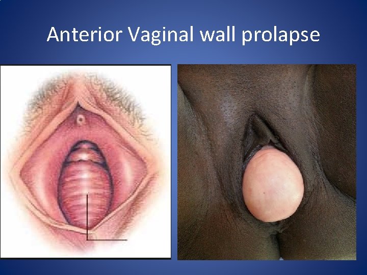 Anterior Vaginal wall prolapse Anterior Vaginal wall prolapse