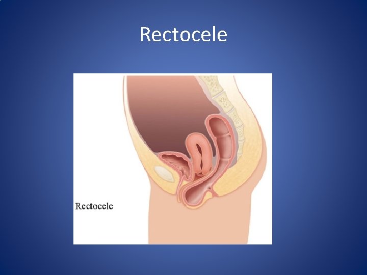 Rectocele 