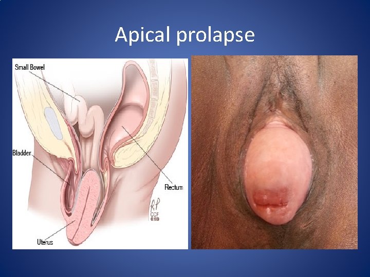Apical prolapse Apical prolapse