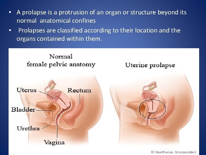  • A prolapse is a protrusion of an organ or structure beyond its