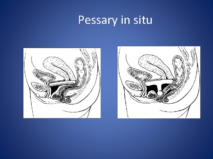 Pessary in situ 