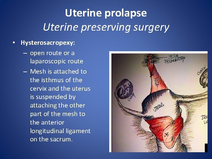 Uterine prolapse Uterine preserving surgery • Hysterosacropexy: – open route or a laparoscopic route