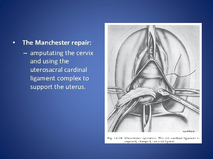 • The Manchester repair: – amputating the cervix and using the uterosacral cardinal • The Manchester repair: – amputating the cervix and using the uterosacral cardinal