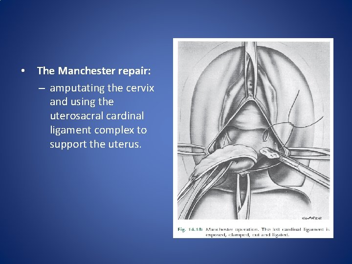 • The Manchester repair: – amputating the cervix and using the uterosacral cardinal