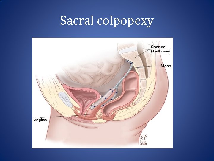 Sacral colpopexy Sacral colpopexy