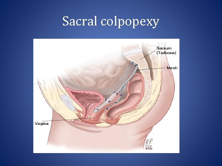 Sacral colpopexy 