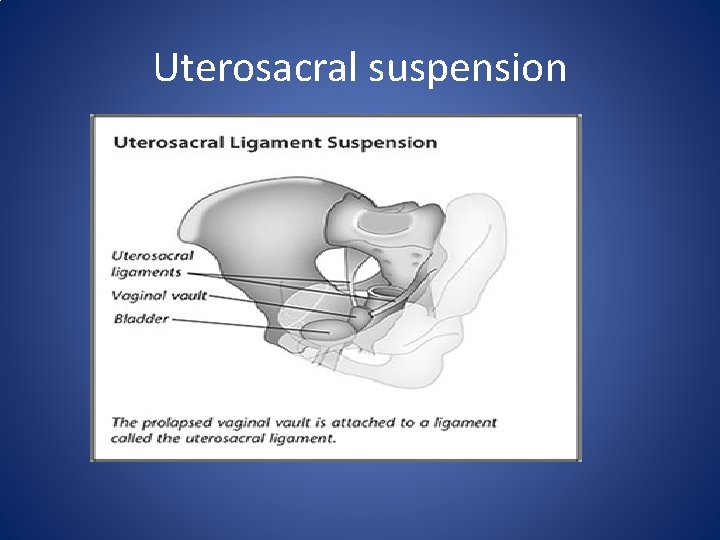 Uterosacral suspension 