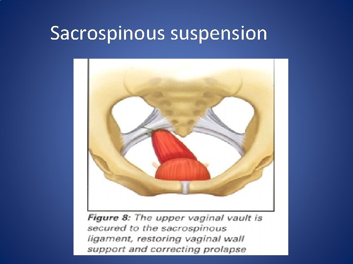 Sacrospinous suspension Sacrospinous suspension