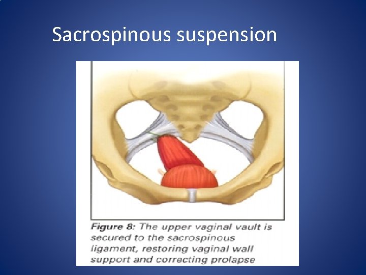 Sacrospinous suspension 