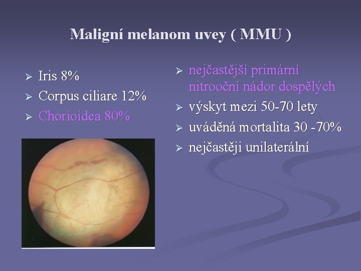 Maligní melanom uvey ( MMU ) Ø Ø Ø Iris 8% Corpus ciliare 12%