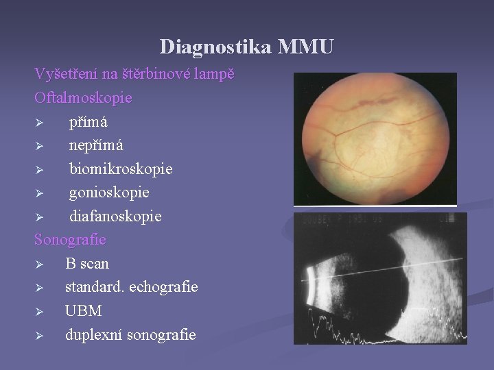 Diagnostika MMU Vyšetření na štěrbinové lampě Oftalmoskopie Ø přímá Ø nepřímá Ø biomikroskopie Ø